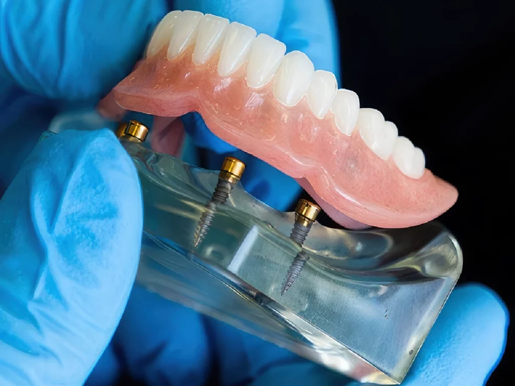 model of lower snap-in implant denture