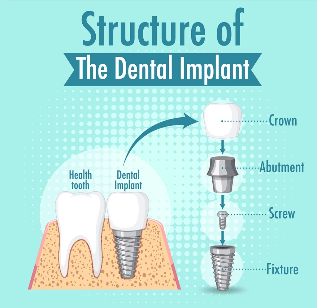the structure of a dental implant